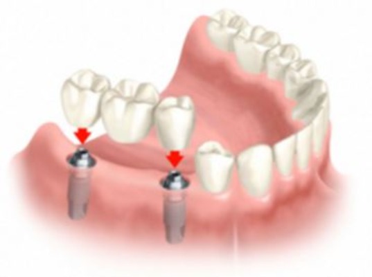 diagram of crowns being placed into mouth