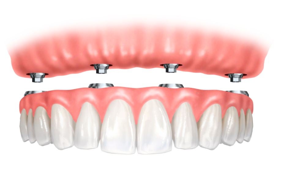 dental implants diagram