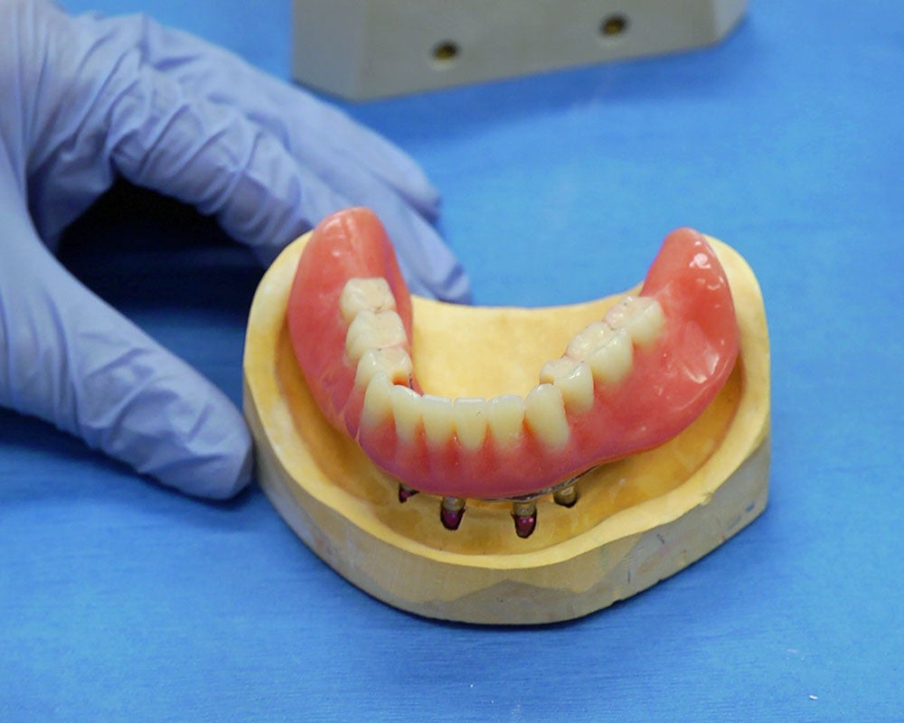 mold of dentures