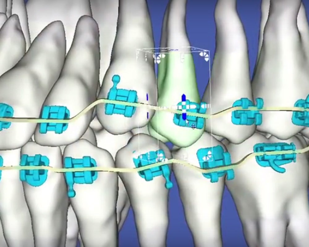 digital teeth with braces