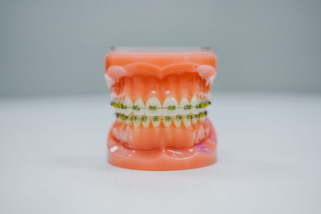 mold of teeth with yellow braces brackets on them