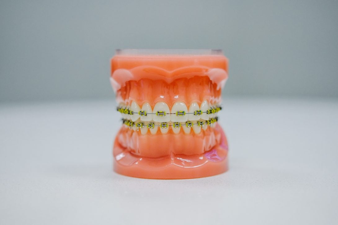 Ceramic Braces  Treatment, Cost & Professional Advice