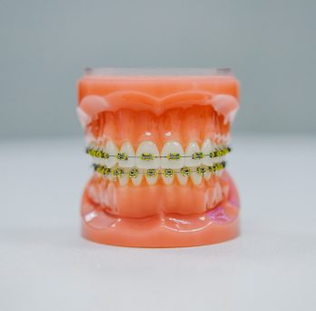 mold of teeth with yellow braces brackets on them 